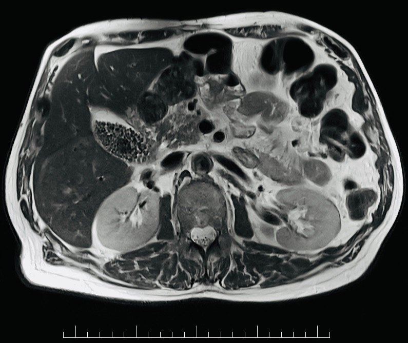 Abdominal MRI image showing gallstones.