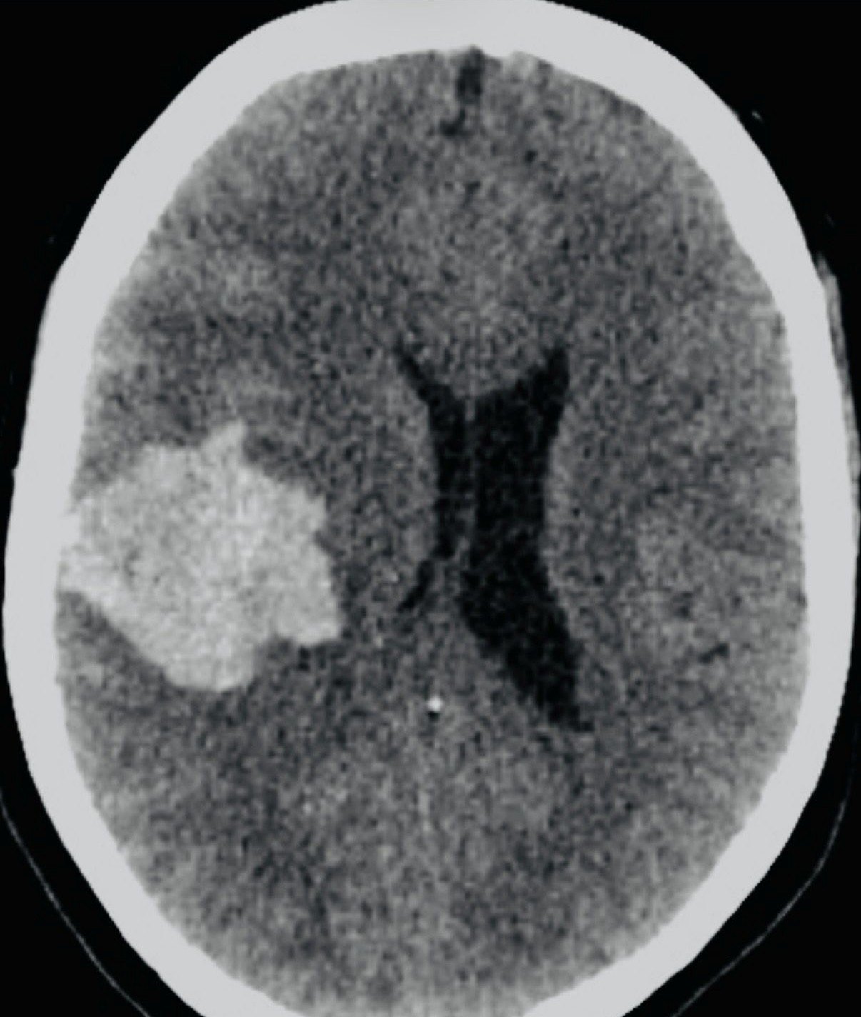 Brain CT image showing intracranial hemorrhage.